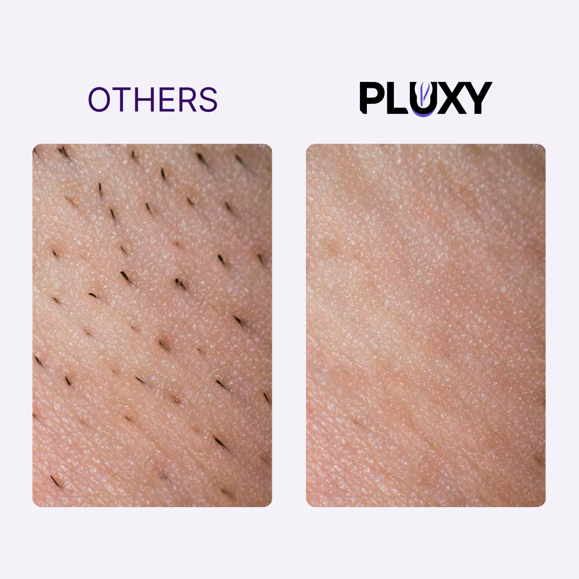 PLUXY™ - BODY EPIL PRO